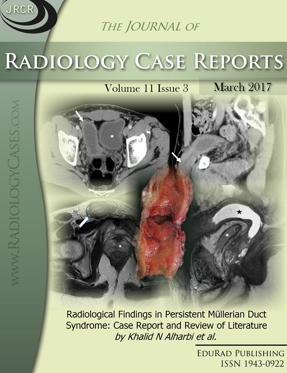 Journal of Radiology Case Reports March 2017 issue - Cover page: Radiological Findings in Persistent Müllerian Duct Syndrome: Case Report and Review of Literature by Khalid N Alharbi et al.