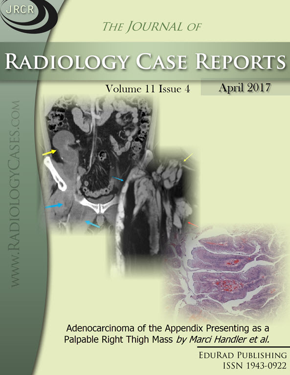 Journal of Radiology Case Reports April 2017 issue - Cover page: Adenocarcinoma of the Appendix Presenting as a Palpable Right Thigh Mass by Marci Handler et al.