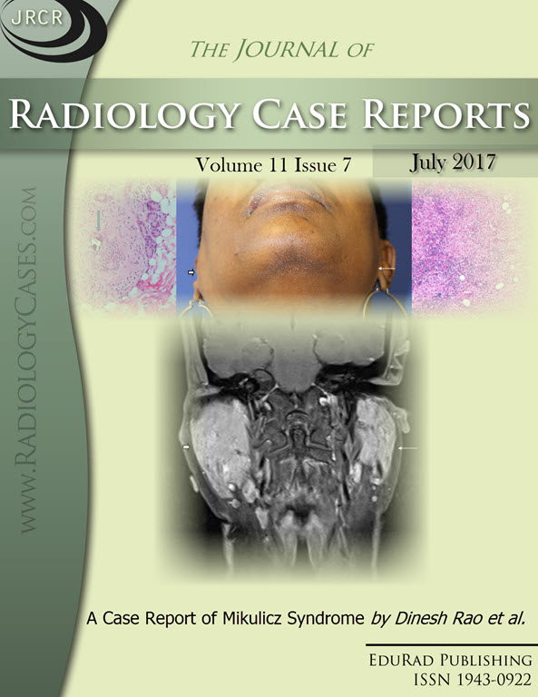 Journal of Radiology Case Reports July 2017 issue - Cover page: A Case Report of Mikulicz Syndrome by Dinesh Rao et al.