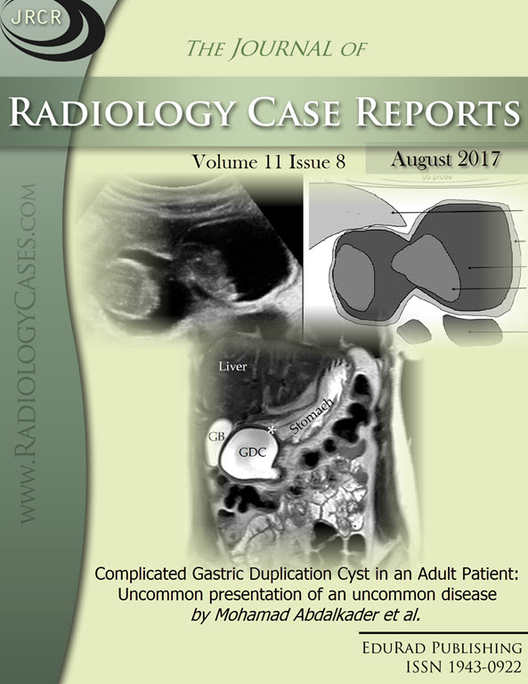 Complicated Gastric Duplication Cyst in an Adult Patient: Uncommon presentation of an uncommon disease by Mohamad Abdalkader et al.