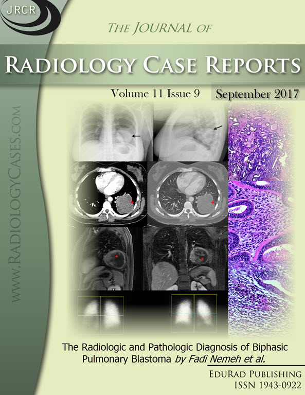 Journal of Radiology Case Reports September 2017 issue - Cover page: The Radiologic and Pathologic Diagnosis of Biphasic Pulmonary Blastoma by Fadi Nemeh et al.