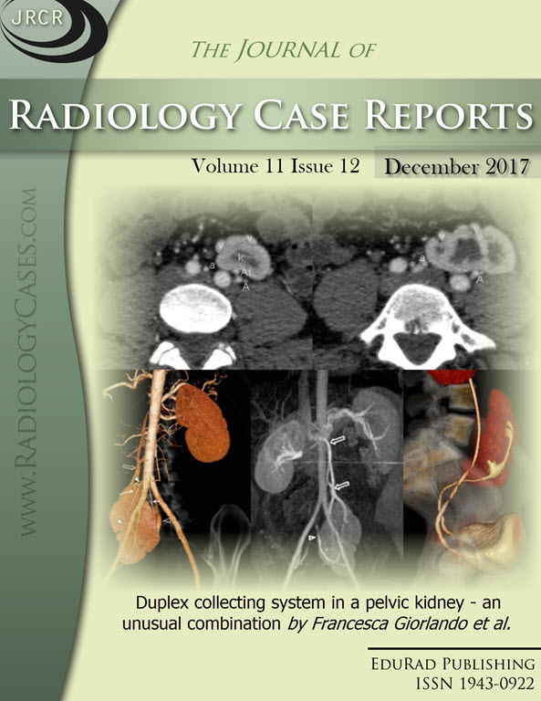 Duplex collecting system in a pelvic kidney - an unusual combination by Francesca Giorlando et al.