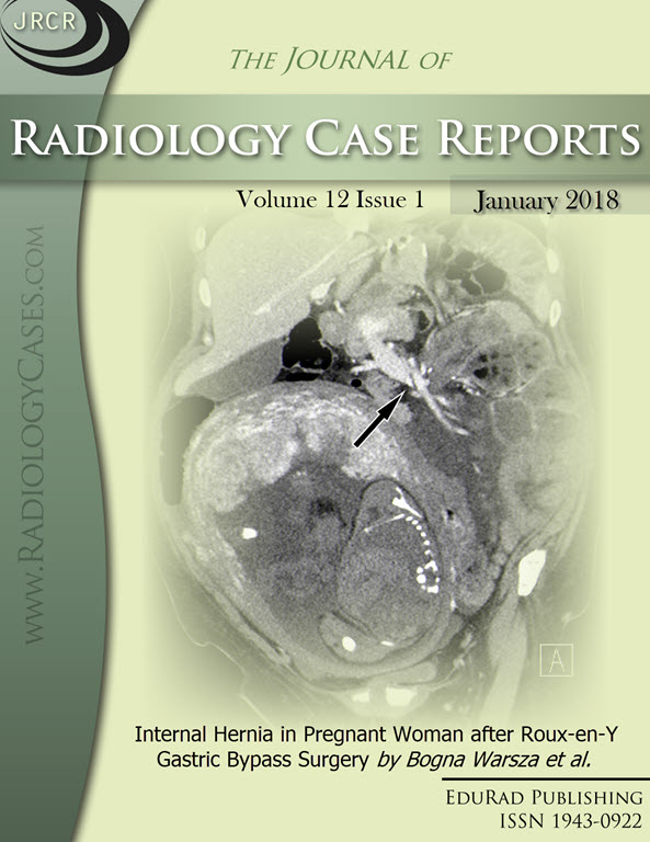 Journal of Radiology Case Reports January 2018 issue - Cover page: Internal Hernia in Pregnant Woman after Roux-en-Y Gastric Bypass Surgery by Bogna Warsza et al.
