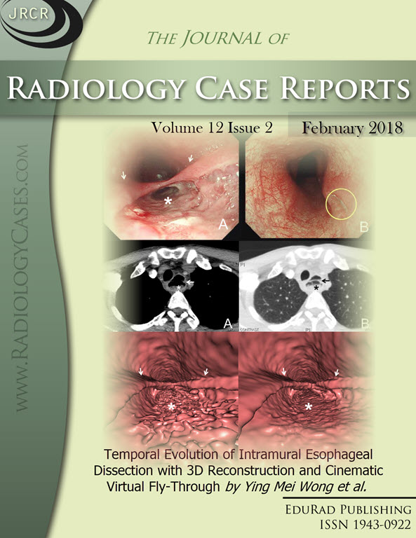 Journal of Radiology Case Reports February 2018 issue - Cover page: Temporal Evolution of Intramural Esophageal Dissection with 3D Reconstruction and Cinematic Virtual Fly-Through by Ying Mei Wong et al.
