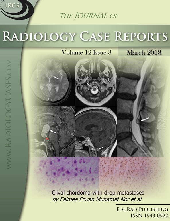 Journal of Radiology Case Reports March 2018 issue - Cover page: Clival chordoma with drop metastases by Faimee Erwan Muhamat Nor et al.