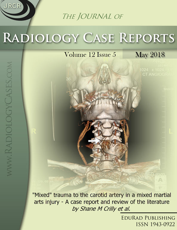 Journal of Radiology Case Reports May 2018 issue - Cover page: "Mixed" trauma to the carotid artery in a mixed martial arts injury - A case report and review of the literature by Shane M Crilly et al.