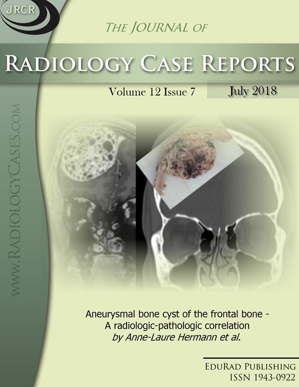 Aneurysmal bone cyst of the frontal bone - A radiologic-pathologic correlation by Anne-Laure Hermann et al.