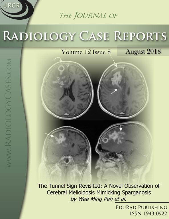 Journal of Radiology Case Reports August 2018 issue - Cover page: The Tunnel Sign Revisited: A Novel Observation of Cerebral Melioidosis Mimicking Sparganosis by Wee Ming Peh et al.