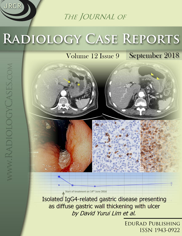 Isolated IgG4-related gastric disease presenting as diffuse gastric wall thickening with ulcer by David Yurui Lim et al.