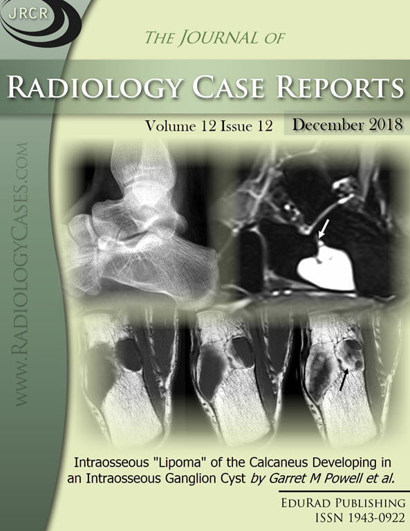 Journal of Radiology Case Reports December 2018 issue - Cover page: Intraosseous "Lipoma" of the Calcaneus Developing in an Intraosseous Ganglion Cyst by Garret M Powell et al.