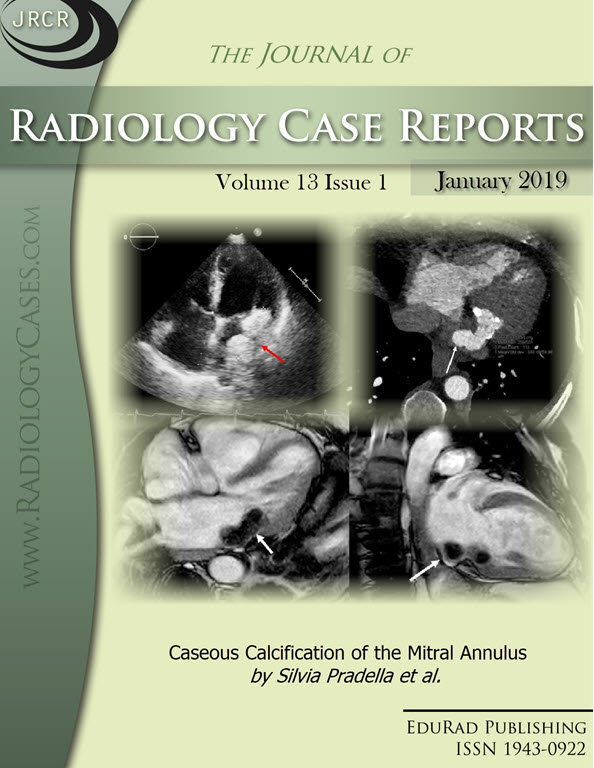 Caseous Calcification of the Mitral Annulus by Silvia Pradella et al.