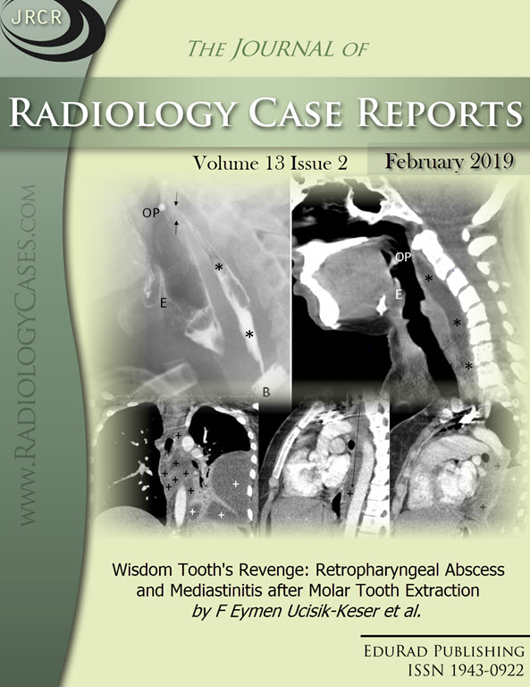 Wisdom Tooth's Revenge: Retropharyngeal Abscess and Mediastinitis after Molar Tooth Extraction by F Eymen Ucisik-Keser et al.