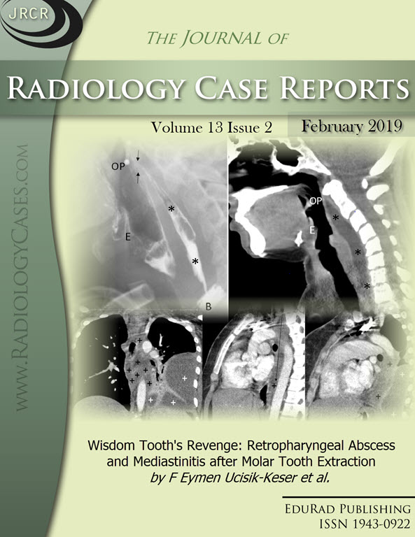 Wisdom Tooth's Revenge: Retropharyngeal Abscess and Mediastinitis after Molar Tooth Extraction by F Eymen Ucisik-Keser et al.