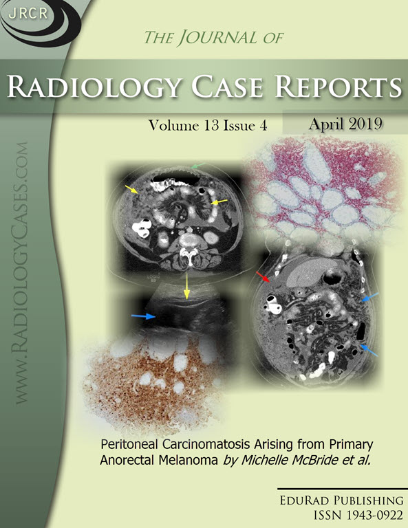 Peritoneal Carcinomatosis Arising from Primary Anorectal Melanoma by Michelle McBride et al.