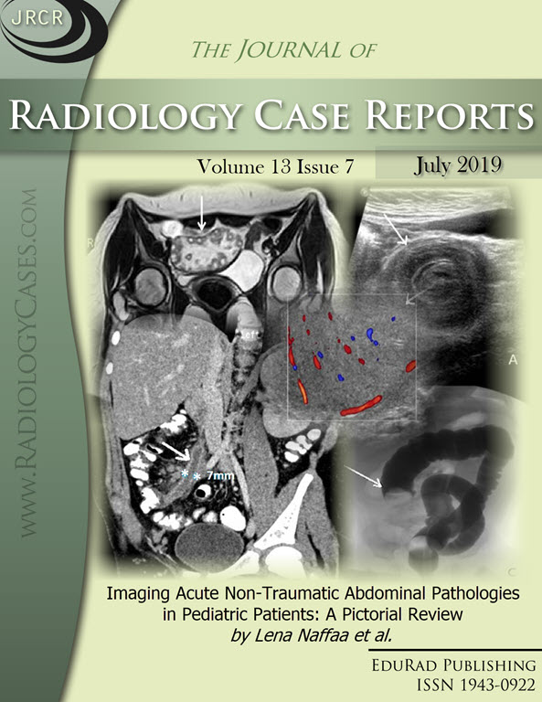 Imaging Acute Non-Traumatic Abdominal Pathologies in Pediatric Patients: A Pictorial Review by Lena Naffaa et al.