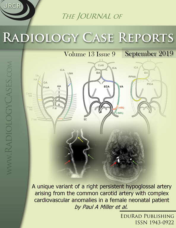 A unique variant of a right persistent hypoglossal artery arising from the common carotid artery with complex cardiovascular anomalies in a female neonatal patient by Paul A Miller et al.