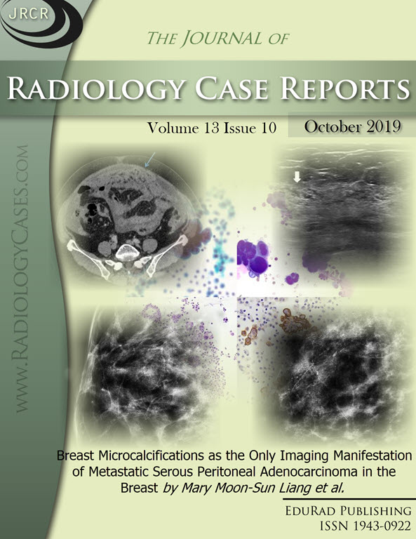 Journal of Radiology Case Reports October 2019 issue - Cover page: Breast Microcalcifications as the Only Imaging Manifestation of Metastatic Serous Peritoneal Adenocarcinoma in the Breast by Mary Moon-Sun Liang et al.