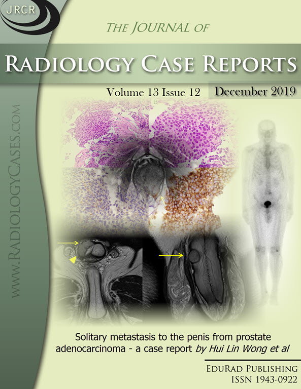 Journal of Radiology Case Reports December 2019 issue - Cover page: Solitary metastasis to the penis from prostate adenocarcinoma - a case report by Hui Lin Wong et al
