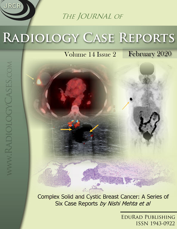 Journal of Radiology Case Reports February 2020 issue - Cover page: Complex Solid and Cystic Breast Cancer: A Series of Six Case Reports by Nishi Mehta et al