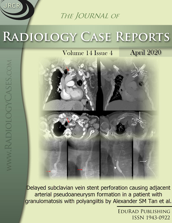 Journal of Radiology Case Reports April 2020 issue - Cover page: Delayed subclavian vein stent perforation causing adjacent arterial pseudoaneurysm formation in a patient with granulomatosis with polyangiitis by Alexander SM Tan et al.