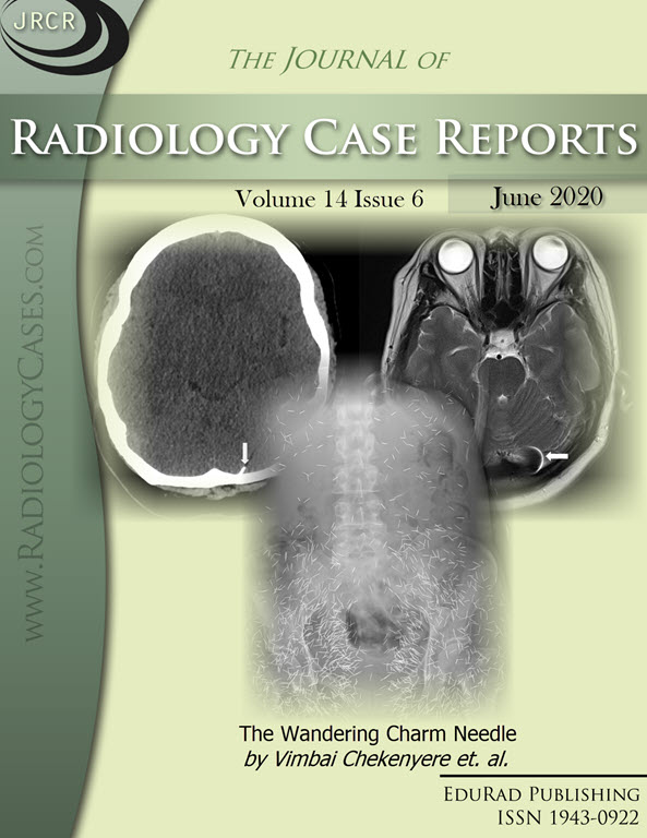 Journal of Radiology Case Reports June 2020 issue - Cover page: The Wandering Charm Needle by Vimbai Chekenyere et. al.