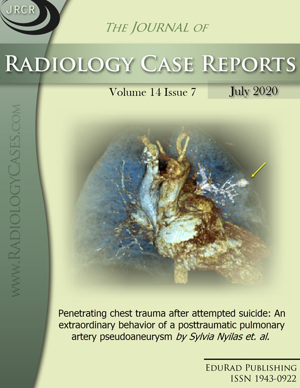 Penetrating chest trauma after attempted suicide: An extraordinary behavior of a posttraumatic pulmonary artery pseudoaneurysm by Sylvia Nyilas et. al.
