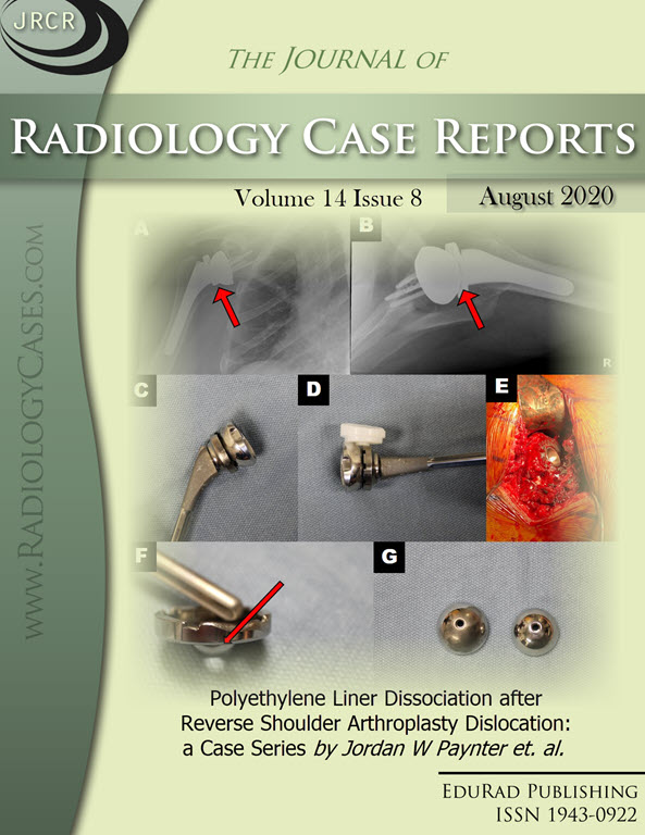 Polyethylene Liner Dissociation after Reverse Shoulder Arthroplasty Dislocation: a Case Series by Jordan W Paynter et. al.