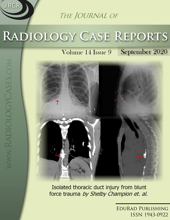 Isolated thoracic duct injury from blunt force trauma by Shelby Champion et. al.