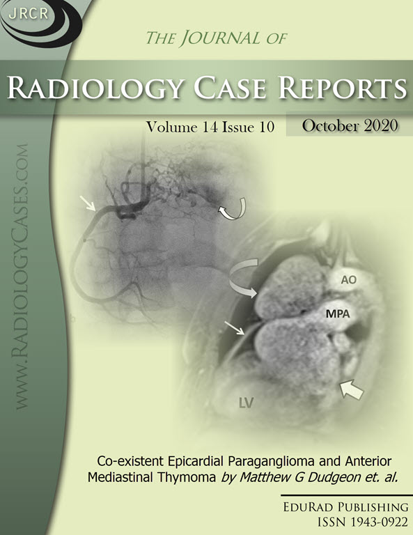 Co-existent Epicardial Paraganglioma and Anterior Mediastinal Thymoma by Matthew G Dudgeon et. al.