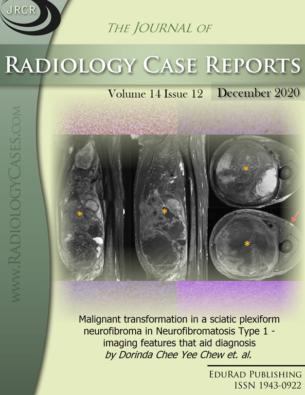 Malignant transformation in a sciatic plexiform neurofibroma in Neurofibromatosis Type 1 - imaging features that aid diagnosis by Dorinda Chee Yee Chew et. al.