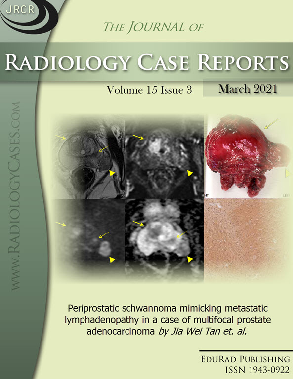 Journal of Radiology Case Reports March 2021 issue - Cover page: Periprostatic schwannoma mimicking metastatic lymphadenopathy in a case of multifocal prostate adenocarcinoma by Jia Wei Tan et al.