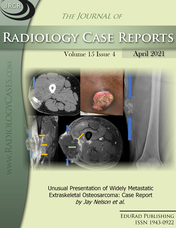 Unusual Presentation of Widely Metastatic Extraskeletal Osteosarcoma: Case Report by Jay Nelson et al.