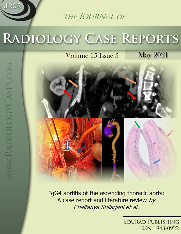 IgG4 aortitis of the ascending thoracic aorta: A case report and literature review by Chaitanya Shilagani et al.