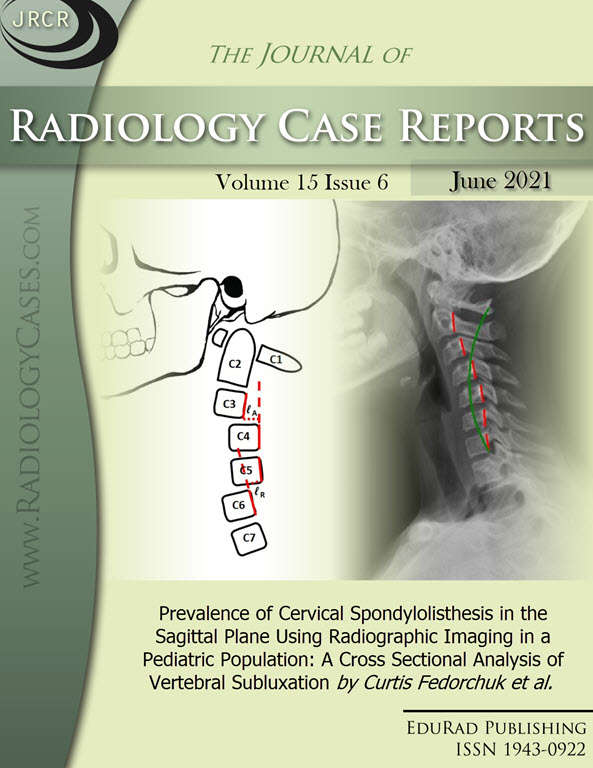 Prevalence of Cervical Spondylolisthesis in the Sagittal Plane Using Radiographic Imaging in a Pediatric Population: A Cross Sectional Analysis of Vertebral Subluxation by Curtis Fedorchuk et al.