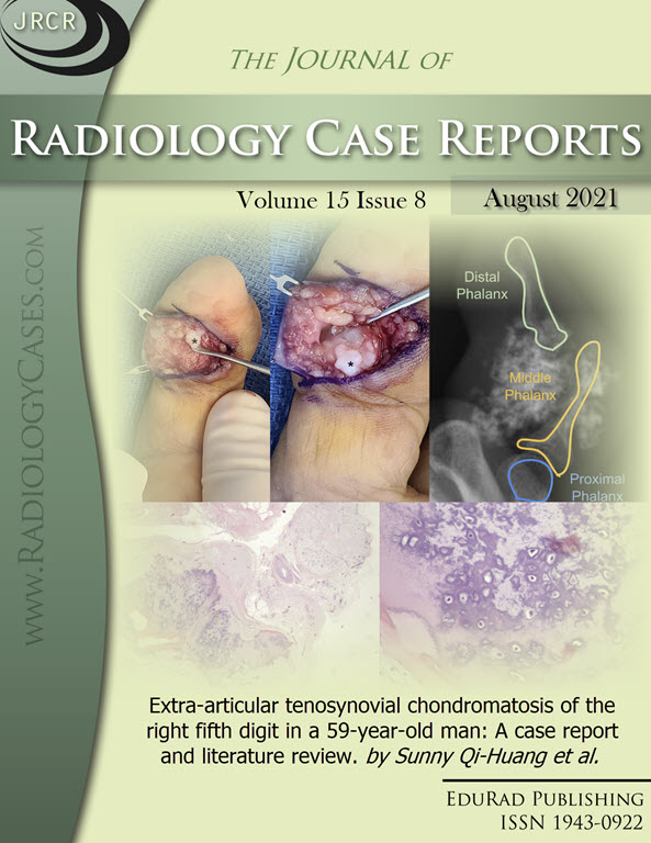 Extra-articular tenosynovial chondromatosis of the right fifth digit in a 59-year-old man: A case report and literature review. by Sunny Qi-Huang et al.