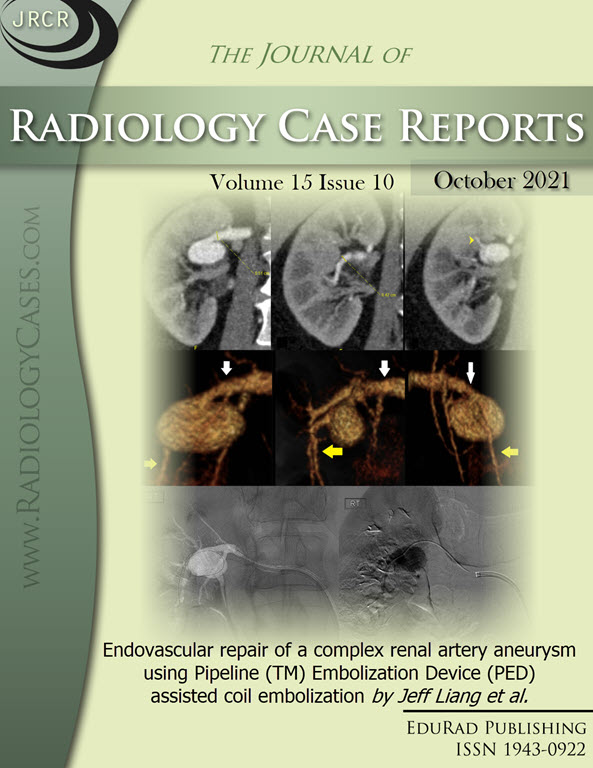 Endovascular repair of a complex renal artery aneurysm using Pipeline (TM) Embolization Device (PED) assisted coil embolization by Jeff Liang et al.