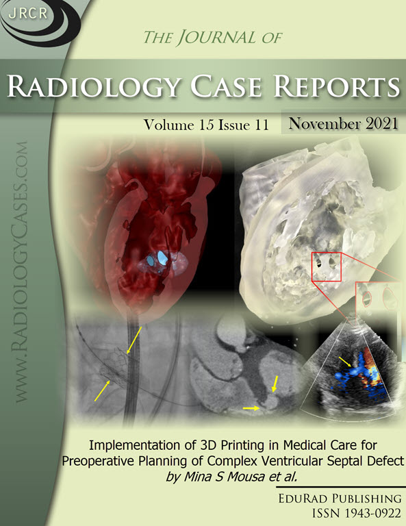 Implementation of 3D Printing in Medical Care for Preoperative Planning of Complex Ventricular Septal Defect by Mina S Mousa et al.