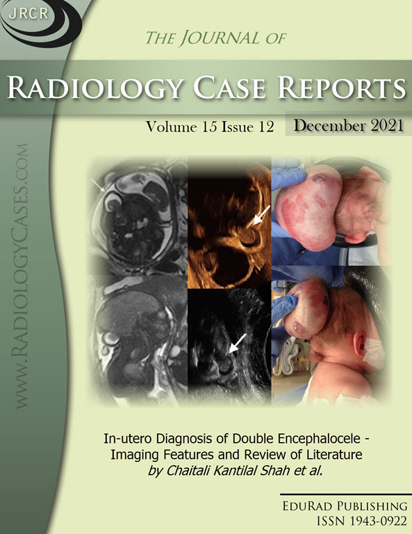 In-utero Diagnosis of Double Encephalocele - Imaging Features and Review of Literature by Chaitali Kantilal Shah et al.