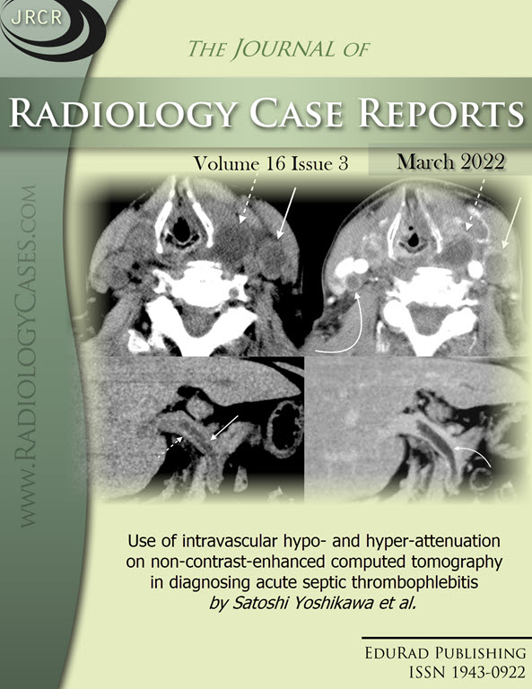 Use of intravascular hypo- and hyper-attenuation on non-contrast-enhanced computed tomography in diagnosing acute septic thrombophlebitis by Satoshi Yoshikawa et al.