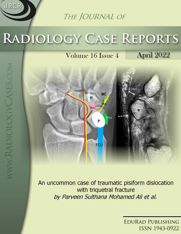 An uncommon case of traumatic pisiform dislocation with triquetral fracture by Parveen Sulthana Mohamed Ali et al.