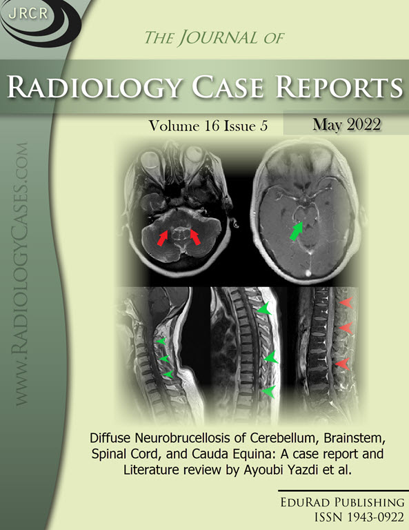 Diffuse Neurobrucellosis of Cerebellum, Brainstem, Spinal Cord, and Cauda Equina: A case report and Literature review by Ayoubi Yazdi et al.