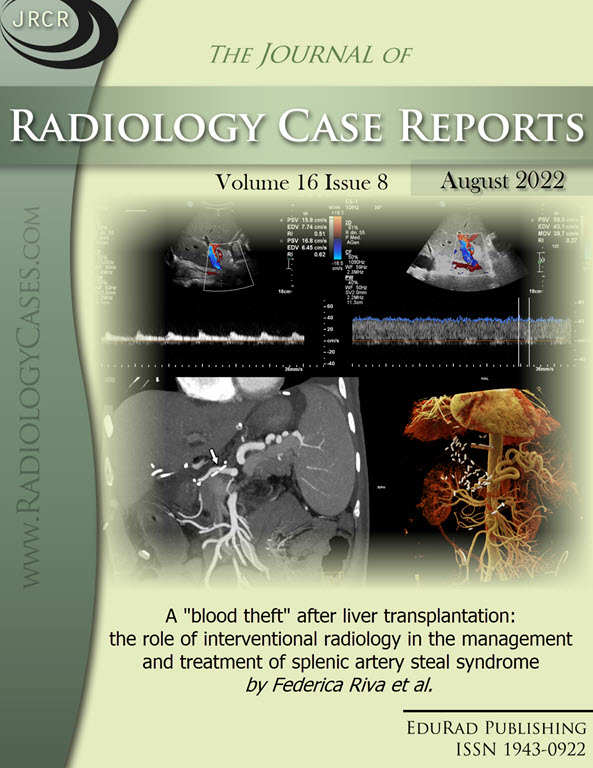 A "blood theft" after liver transplantation: the role of interventional radiology in the management and treatment of splenic artery steal syndrome by Federica Riva et al.