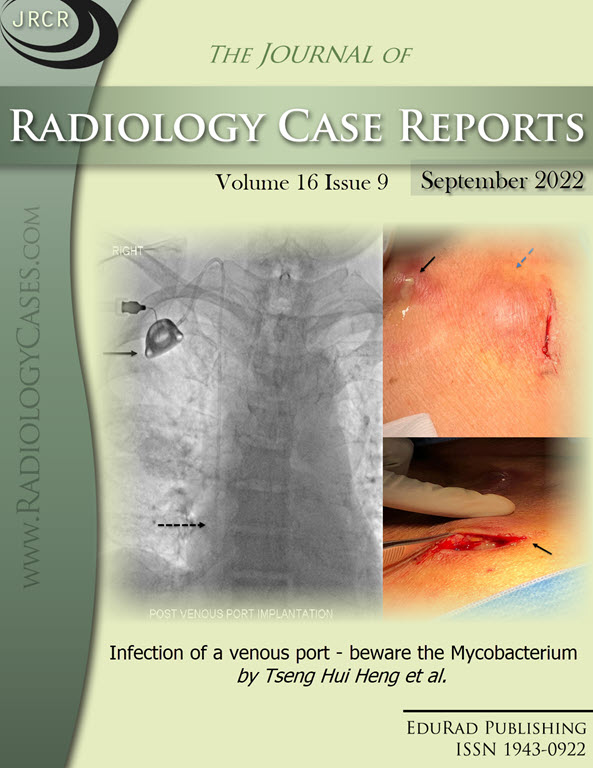 Infection of a venous port - beware the Mycobacterium by Tseng Hui Heng et al.