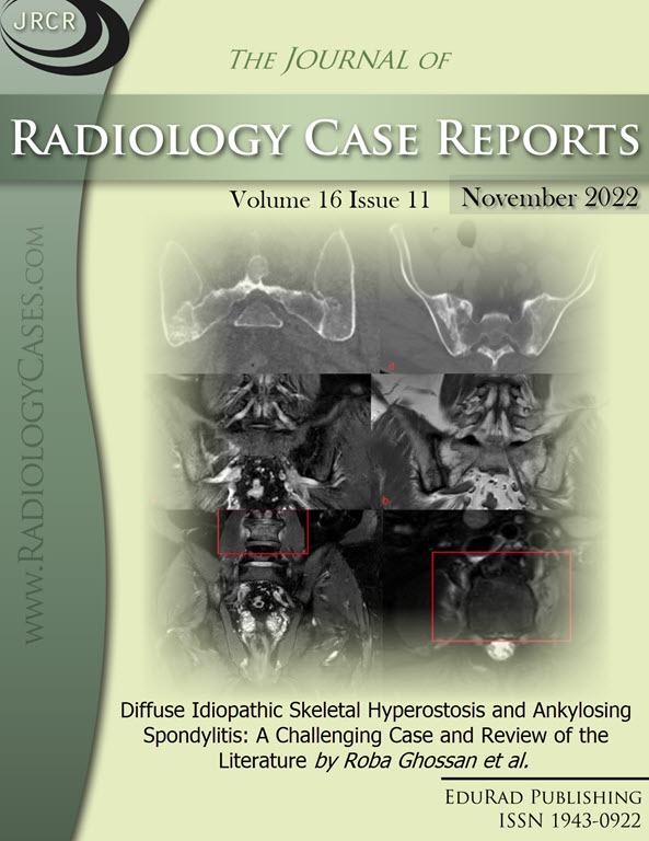 Diffuse Idiopathic Skeletal Hyperostosis and Ankylosing Spondylitis: A Challenging Case and Review of the Literature by Roba Ghossan et al.