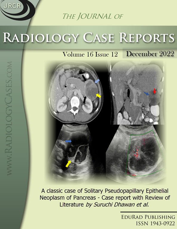 A classic case of Solitary Pseudopapillary Epithelial Neoplasm of Pancreas - Case report with Review of Literature by Suruchi Dhawan et al.