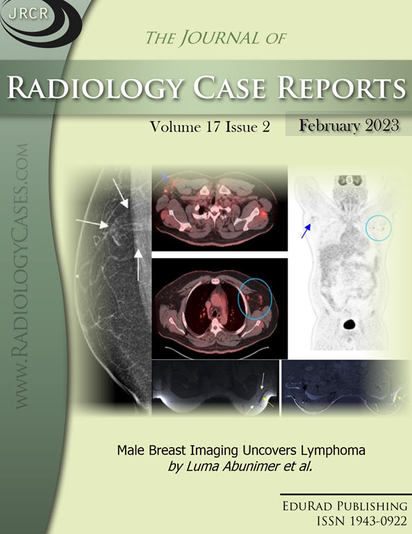 Male Breast Imaging Uncovers Lymphoma by Luma Abunimer et al.