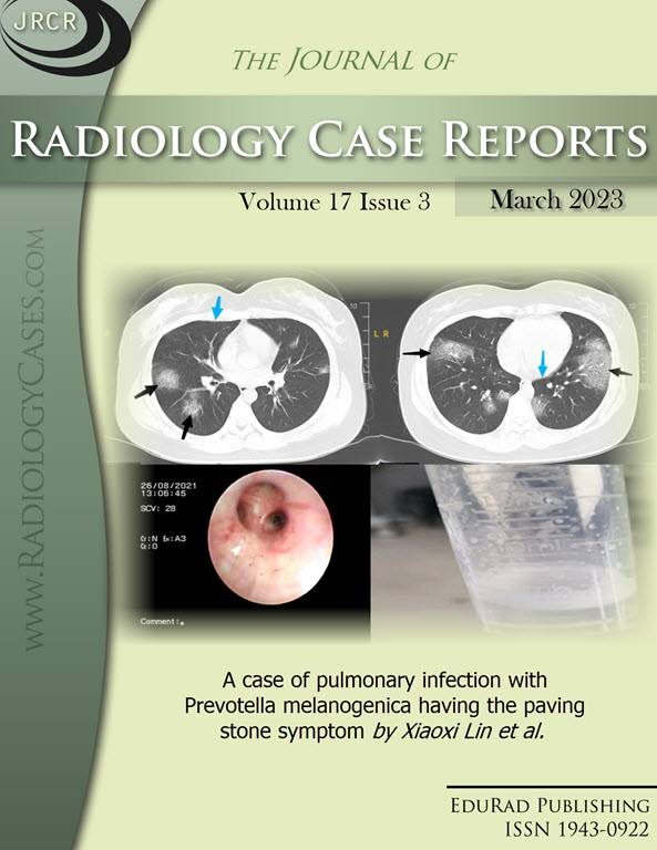 A case of pulmonary infection with Prevotella melanogenica having the paving stone symptom by Xiaoxi Lin et al.