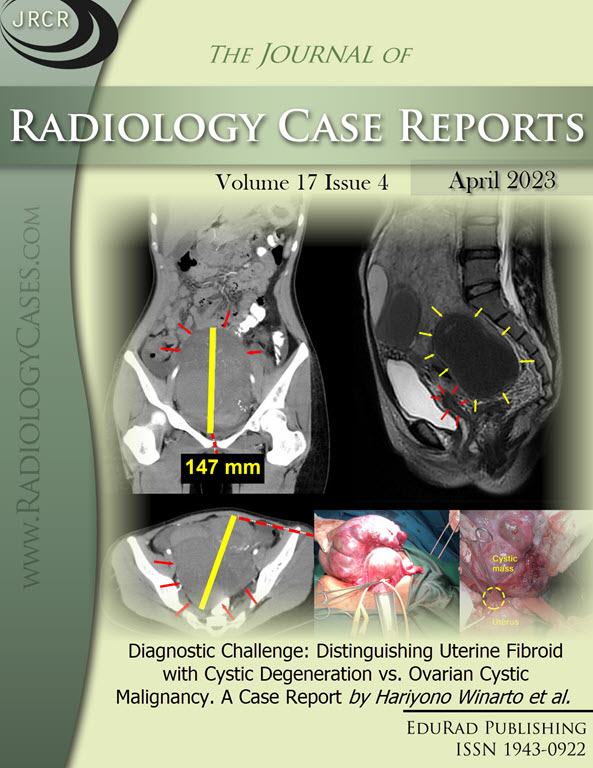 Diagnostic Challenge: Distinguishing Uterine Fibroid with Cystic Degeneration vs. Ovarian Cystic Malignancy. A Case Report by Hariyono Winarto et al.