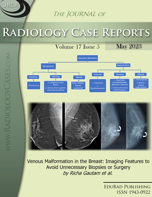 Journal of Radiology Case Reports May 2023 issue cover page: Venous Malformation in the Breast: Imaging Features to Avoid Unnecessary Biopsies Or Surgery by Richa Gautam et al