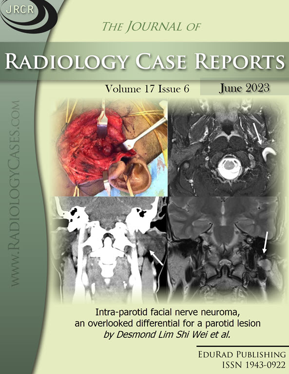 Journal of Radiology Case Reports June 2023 issue: Intra-parotid facial nerve neuroma, an overlooked differential for a parotid lesion by Desmond Lim Shi Wei et al.